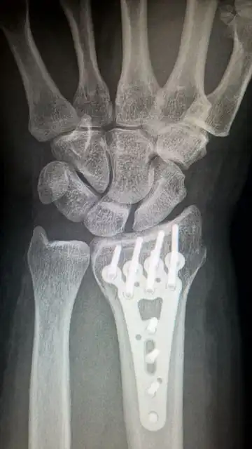 broken-arms image