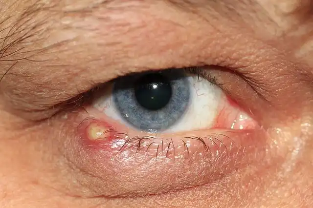 eye-inflammation image